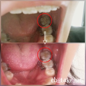 歯列矯正中の虫歯治療 201811