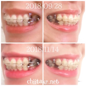 インプラント矯正-1ヵ月での歯の動き-犬歯の位置 201811