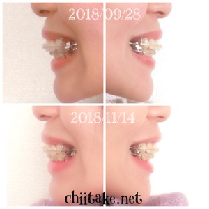 インプラント矯正-1ヵ月での歯の動き-横顔 201811