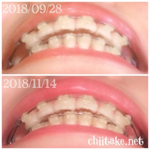 インプラント矯正-1ヵ月での歯の動き-上下の歯の距離感 201811