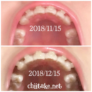 インプラント矯正-1ヵ月での歯の動き-下から見る上の歯 201812