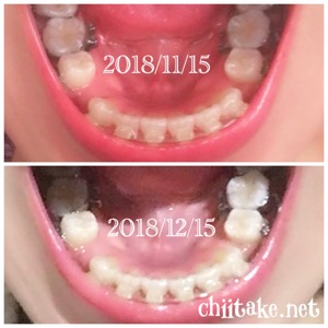 インプラント矯正-1ヵ月での歯の動き-上から見る下の歯 201812
