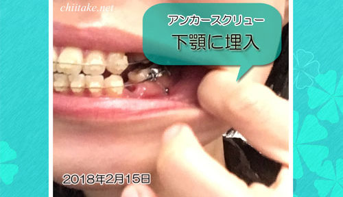 歯科矯正用アンカースクリューを下顎に打ち込み 20180215