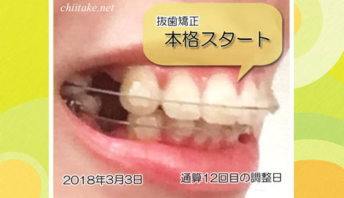 表側装置(セラミックブラケット)での上下抜歯矯正開始 20180303