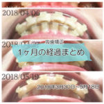 表側装置(セラミックブラケット)による歯の動き経過まとめ 20180330-20180519