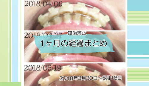 表側装置(セラミックブラケット)による歯の動き経過まとめ 20180330-20180519