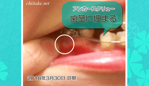 下顎に打った歯科矯正用アンカースクリューが歯茎に埋もれる-01