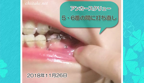 歯列矯正用アンカースクリューを左下5番と6番の間に打ち直し 201811