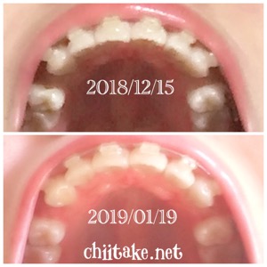 インプラント矯正-1ヵ月での歯の動き-下から見る上の歯 201901