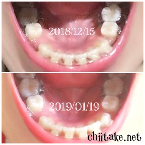 インプラント矯正-1ヵ月での歯の動き-上から見る下の歯 201901