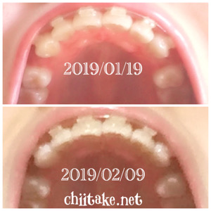 インプラント矯正-1ヵ月での歯の動き-下から見る上の歯 2019012