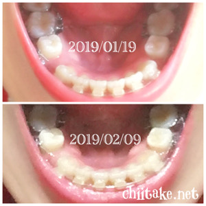 インプラント矯正-1ヵ月での歯の動き-上から見る下の歯 201902
