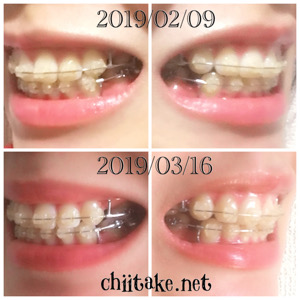 インプラント矯正-1ヵ月での歯の動き-犬歯の位置 201903