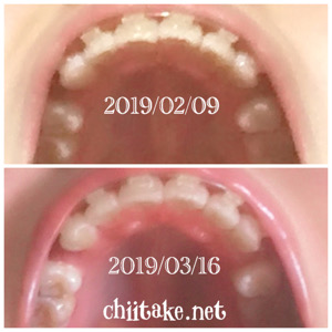 インプラント矯正-1ヵ月での歯の動き-下から見る上の歯 201903