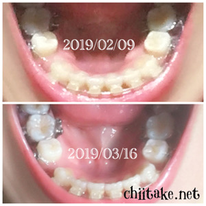 インプラント矯正-1ヵ月での歯の動き-上から見る下の歯 201903