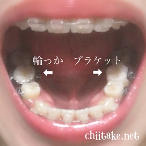 [歯列矯正]下の歯 - 右は輪っか(バンド),左はブラケット