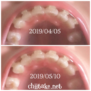 インプラント矯正-1ヵ月での歯の動き-下から見る上の歯 201905