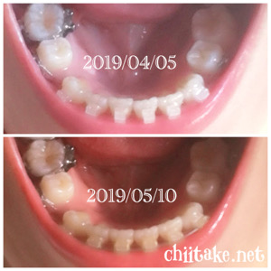 インプラント矯正-1ヵ月での歯の動き-上から見る下の歯 201905