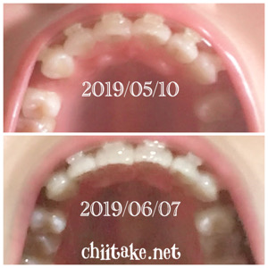 インプラント矯正-1ヵ月での歯の動き-下から見る上の歯 201906