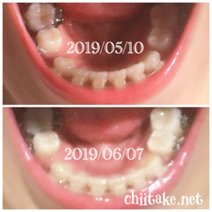 インプラント矯正-1ヵ月での歯の動き-上から見る下の歯 201906