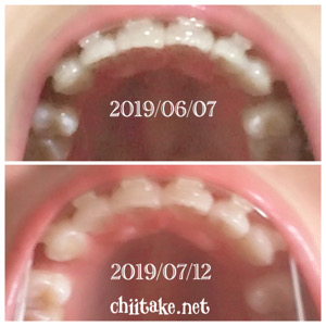 インプラント矯正-1ヵ月での歯の動き-下から見る上の歯 201907