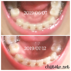 インプラント矯正-1ヵ月での歯の動き-上から見る下の歯 201907