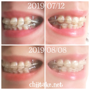 インプラント矯正-1ヵ月での歯の動き-犬歯の位置 201908