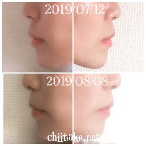 インプラント矯正-1ヵ月での歯の動き-横顔(Eライン) 201908