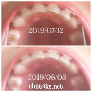 インプラント矯正-1ヵ月での歯の動き-下から見る上の歯 201908