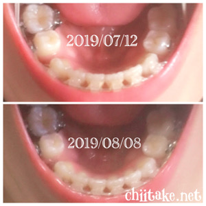 インプラント矯正-1ヵ月での歯の動き-上から見る下の歯 201908