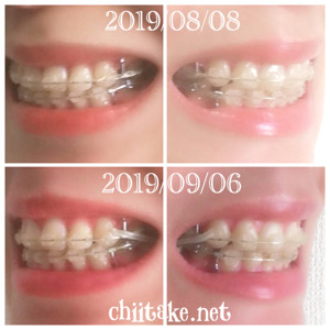 インプラント矯正-1ヵ月での歯の動き-犬歯の位置 201909