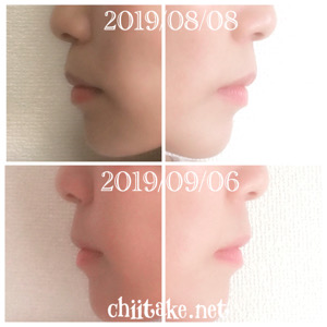 インプラント矯正-1ヵ月での歯の動き-横顔(Eライン) 201909
