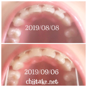 インプラント矯正-1ヵ月での歯の動き-下から見る上の歯 201909
