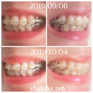インプラント矯正-1ヵ月での歯の動き-犬歯の位置 201910