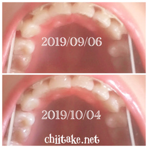 インプラント矯正-1ヵ月での歯の動き-下から見る上の歯 201910