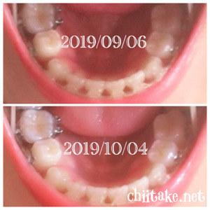 インプラント矯正-1ヵ月での歯の動き-上から見る下の歯 201910
