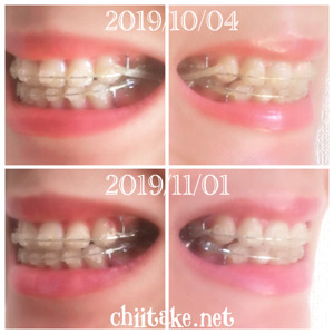 インプラント矯正-1ヵ月での歯の動き-犬歯の位置 201911