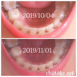 インプラント矯正-1ヵ月での歯の動き-上から見る下の歯 201911
