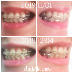 インプラント矯正-1ヵ月での歯の動き-犬歯の位置 201912