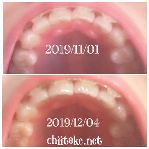 インプラント矯正-1ヵ月での歯の動き-下から見る上の歯 201912