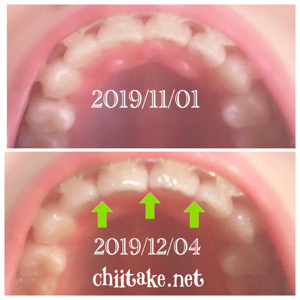 インプラント矯正-1ヵ月での歯の動き-上前歯が若干隙っ歯気味 201912