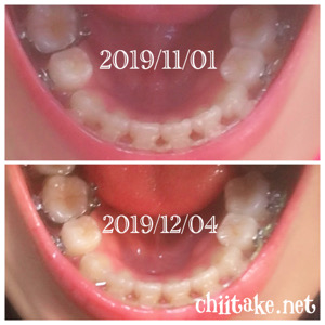 インプラント矯正-1ヵ月での歯の動き-上から見る下の歯 201912