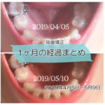 インプラント矯正 歯の動き経過まとめ 20190404-20190509