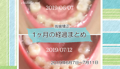 インプラント矯正 歯の動き経過まとめ 20190607-20190711