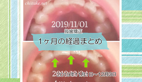 インプラント矯正 歯の動き経過まとめ 20191101-20191203