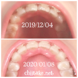 インプラント矯正-1ヵ月での歯の動き-下から見る上の歯 202001