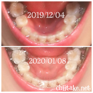 インプラント矯正-1ヵ月での歯の動き-上から見る下の歯 202001