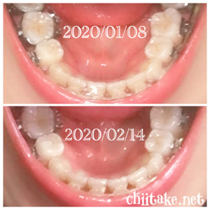 インプラント矯正-1ヵ月での歯の動き-上から見る下の歯 202002