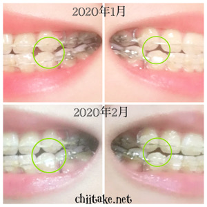 インプラント矯正 - 犬歯の先端が噛み合わない - 2020年1月と2月の比較写真
