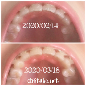 インプラント矯正-1ヵ月での歯の動き-下から見る上の歯 202003
